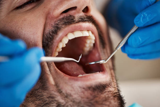 Best Dentist for Tooth Abscess  in Janesville, CA